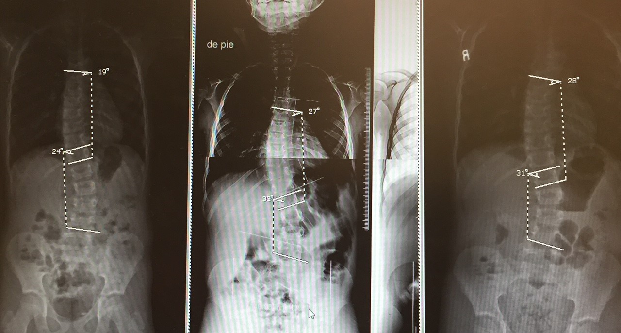 Alonzo’s Juvenile Scoliosis Story: An International Trip to Avoid Surgery