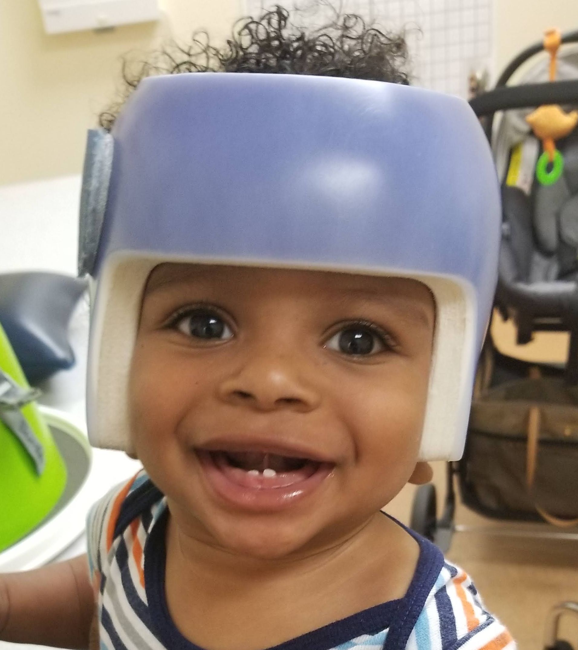 The Boston Band as a Single Helmet Solution for Plagiocephaly