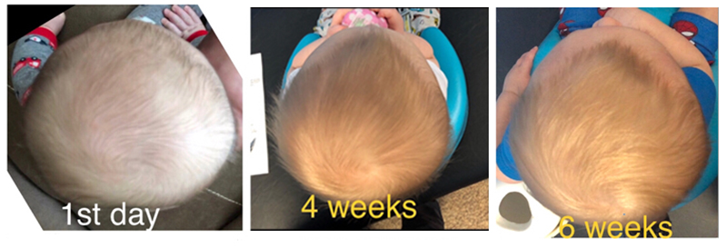 Flat spot on infant deals head
