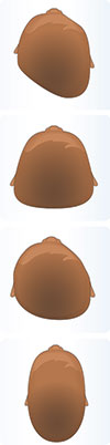 Illustration of the different types of cranial asymmetry