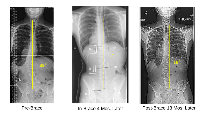 Scoliosis Curve Corrections Wearing the Boston Brace 3D