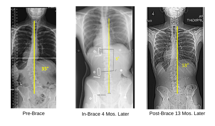 Scoliosis correction