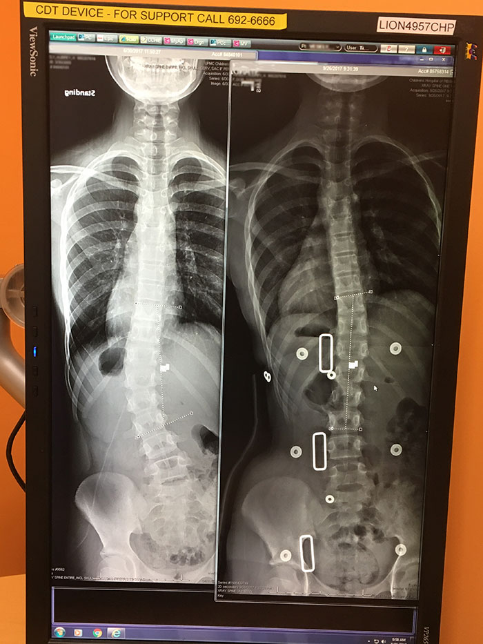 Scoliosis Bracing Case Study: Boston Brace 3D Achieves Impressive Curve Correction