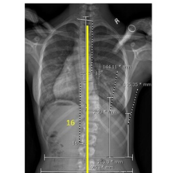 Can Bracing Correct Spinal Curves from Scoliosis?