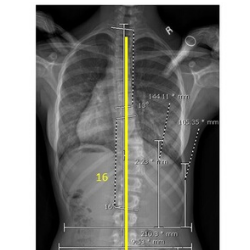 Boston Brace: First Check before X-Ray - Scoliosis and Spine Online Learning